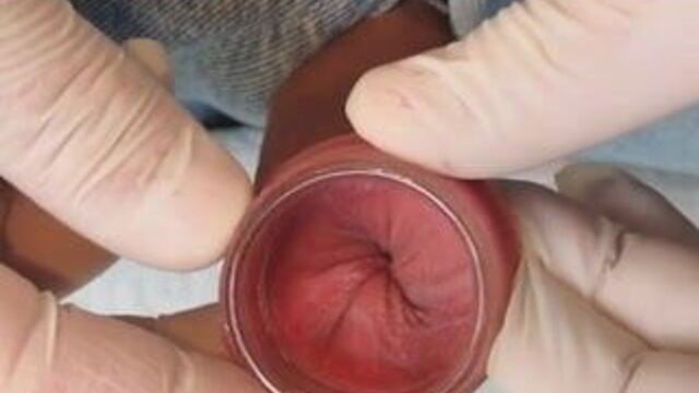 Glass tunnel in the foreskin.